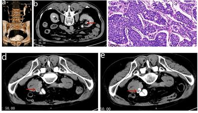 Case report: A case of neoadjuvant immunotherapy in combination with the Yang–Monti technique for the treatment of ureteral carcinoma after radical cystectomy and left radical nephroureterectomy